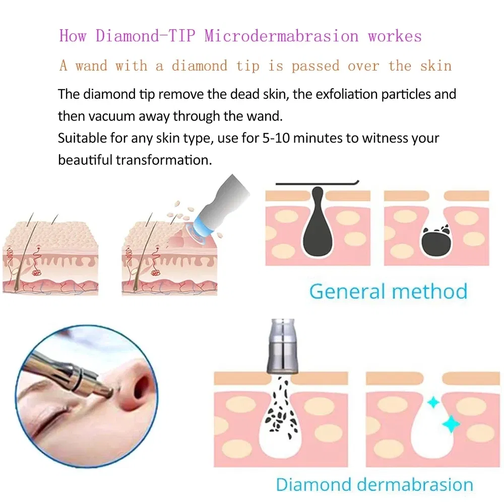 Color: Gold, Ships From: CN, Power Source: UK - Microdermabrasion Facial Diamond Dermabrasion Machine Portable Blackhead Acne Pore Cleaning Beauty Device Rejuvenation Peeling