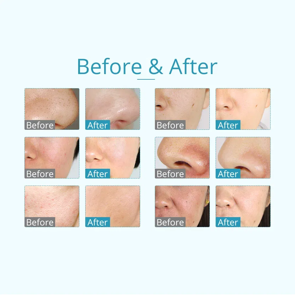 Color: White, Ships From: CHINA - 3 In 1 Vacuum Diamond Tip Microdermabrasion Machine Acne Blackhead Removal Skin Rejuvenation Water Spray Facial Beauty Machine