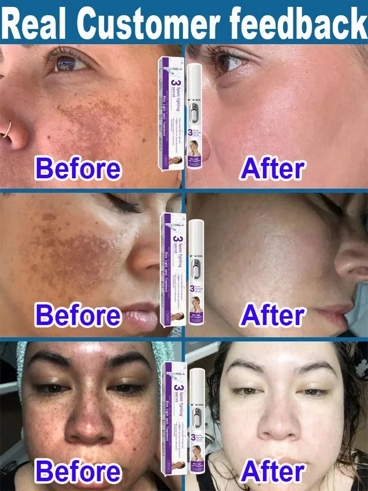 Color: green - ?โฆ?ยซ๐๐?ยค๐ฅ๐ ?ยซ๐?ยฆ๐จ๐ฏ๐๐ฅ Laser Therapy to Heal Spots