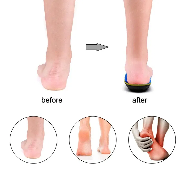 IFITNA Flat Feet Orthopedic Insoles Arch Support Template Plantar Fasciitis Orthotics Heel Pain Inserts Boots Sneaker Men Women