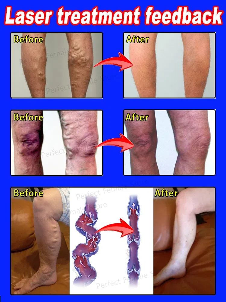 Color: Blue - Varicose Veins Products