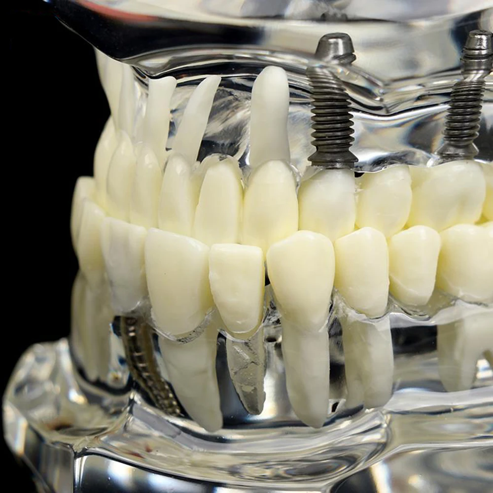 Dental Models Repairable Resin Models Of Diseased Teeth For Teaching And Research In Medicine And Dental Diseases