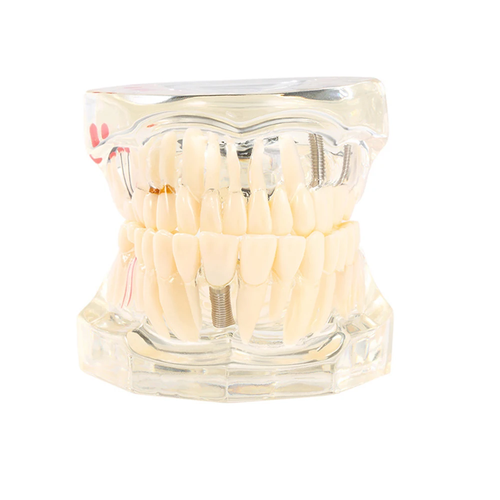 Dental Models Repairable Resin Models Of Diseased Teeth For Teaching And Research In Medicine And Dental Diseases
