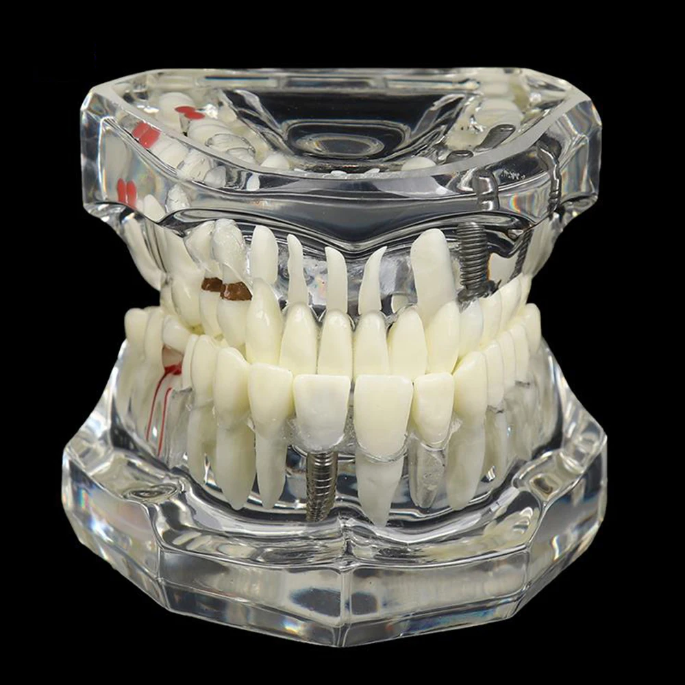 Dental Models Repairable Resin Models Of Diseased Teeth For Teaching And Research In Medicine And Dental Diseases