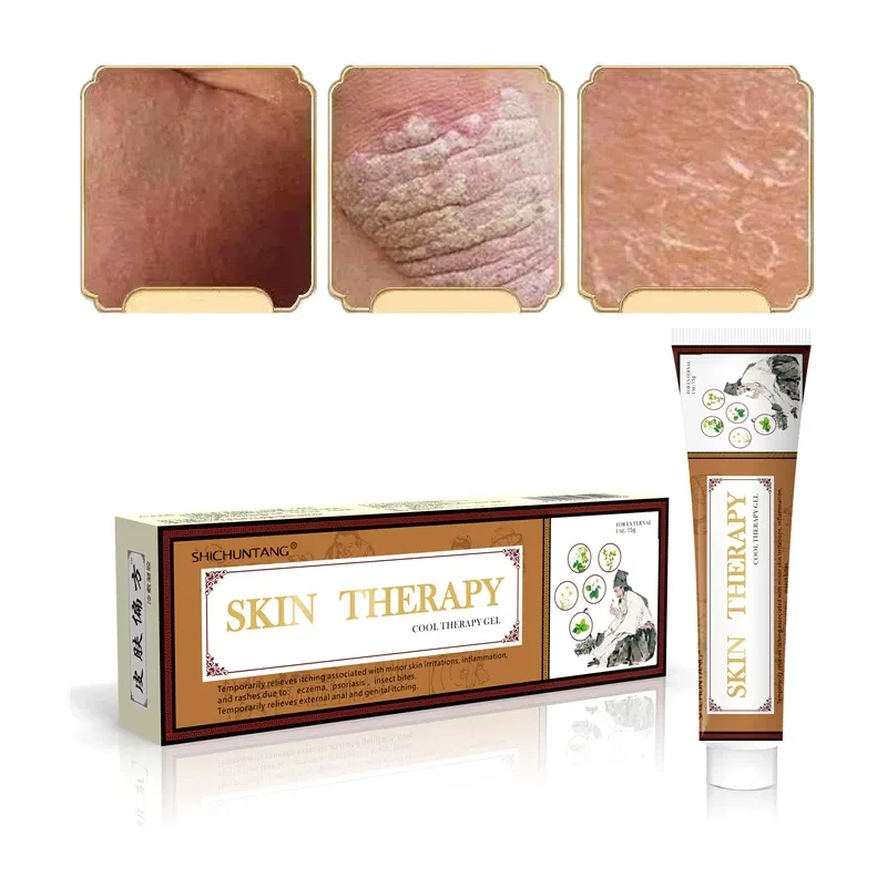 Psoriasis Cream Skin Skin care lotion