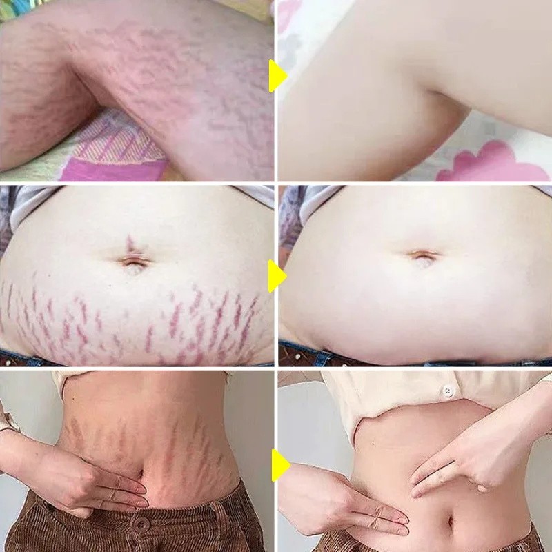 Stretch Marks Permanent Removal Cream - Skin Repair and Firming Care