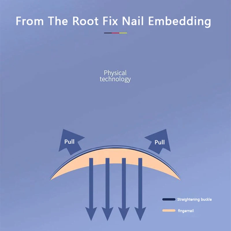 Ingrown Toenail Corrector Tools Pedicure Recover Embed Toe Nail Treatment Professional Ingrown Toenail Correction Foot CareTool