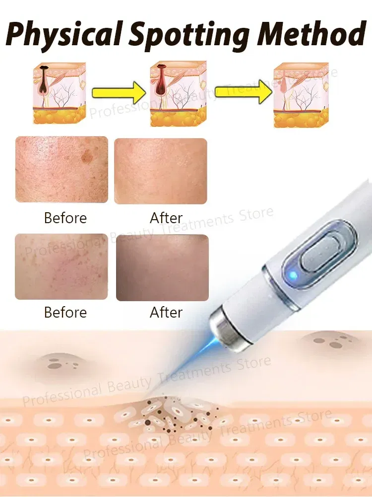 Color: black - ?โฆ?ยซ๐๐?ยค๐ฅ๐ ?ยซ๐?ยฆ๐จ๐ฏ๐๐ฅ Laser Therapy to Heal Spots