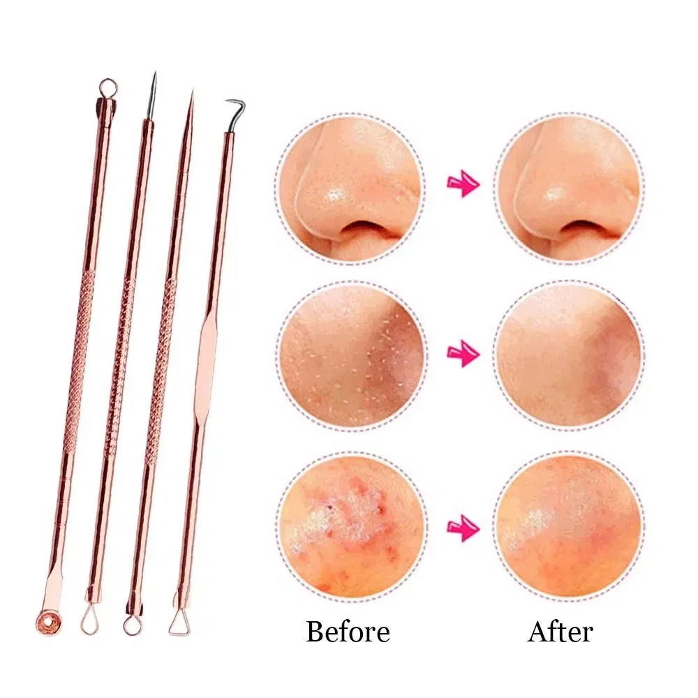 Color: Reseda - 4PCS Stainless Steel Acne Needle Electroplating Colorful Rose Gold Acne Needle Extrusion Blackhead Tool Can Be Customized LOGO